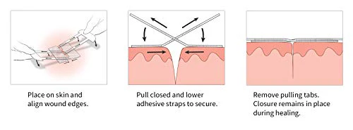 Clozex Emergency Laceration Closures - Repair Wounds Without Stitches. FDA Cleared Skin Closure Device for 3 Individual Wounds or Combine for Total Le - Image 5